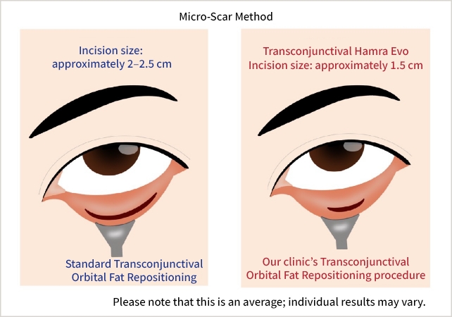 Small and less noticeable scars with the Micro-Scar Method
