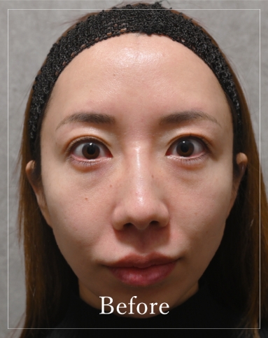 Before treatment