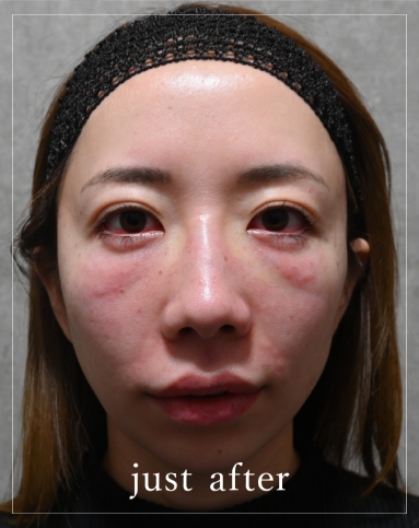 Immediately after treatment