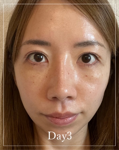 3 days after treatment