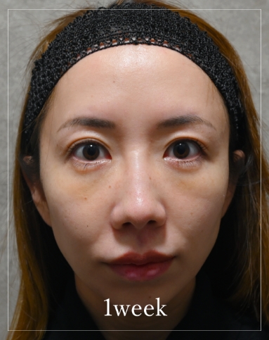 1 week after treatment