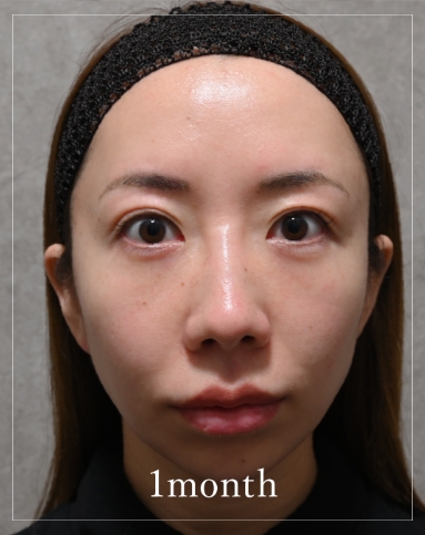 1 month after treatment
