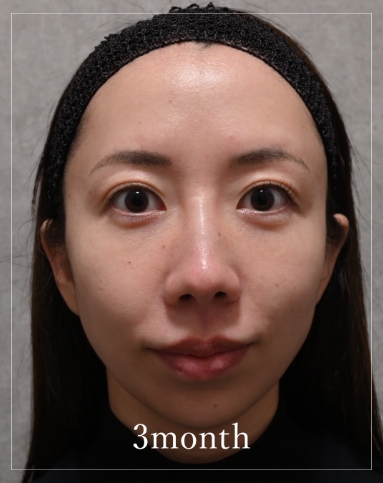 3 months after treatment