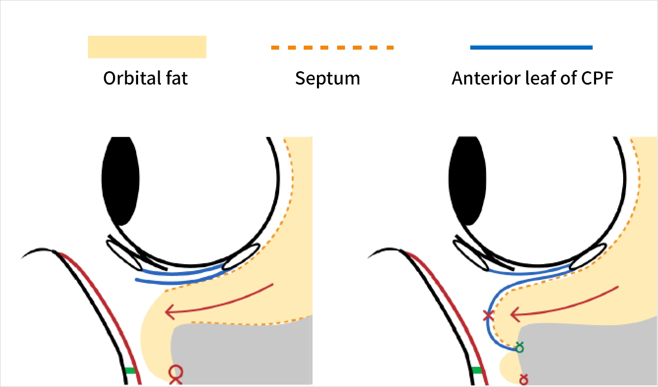 CPF round-type repositioning enhances recurrence prevention