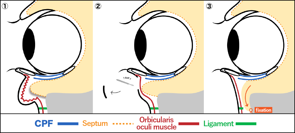 What is Subciliary Orbital Fat Repositioning?