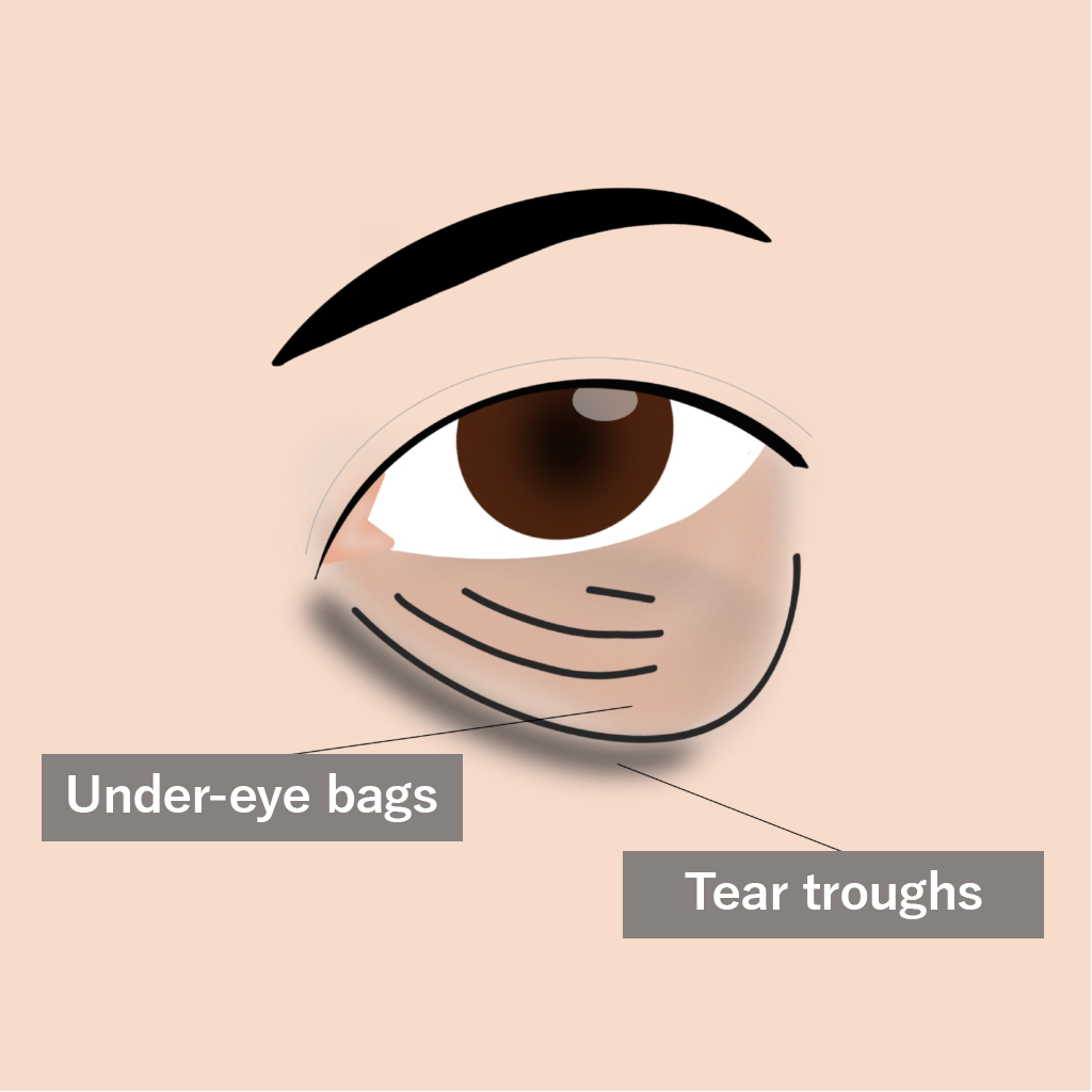 Candidates for Subciliary Orbital Fat Repositioning