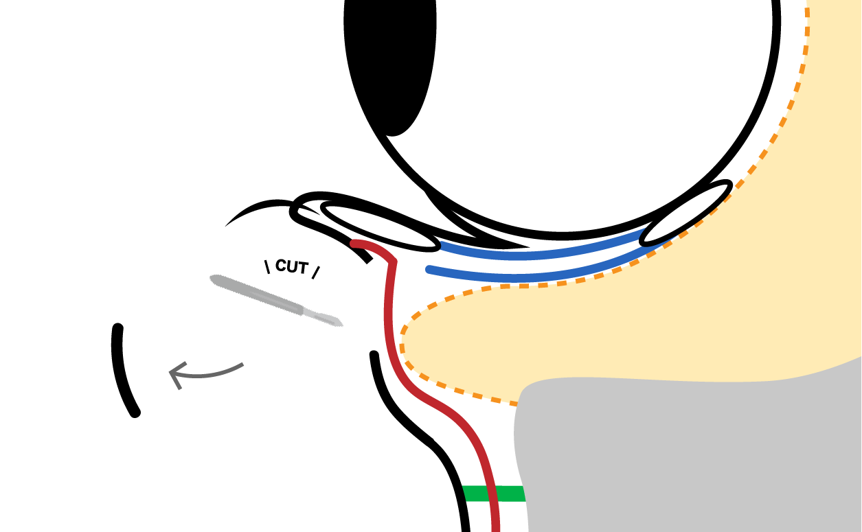 An incision is made in a discreet area near the lower eyelashes, and the sagging excess skin is carefully removed.