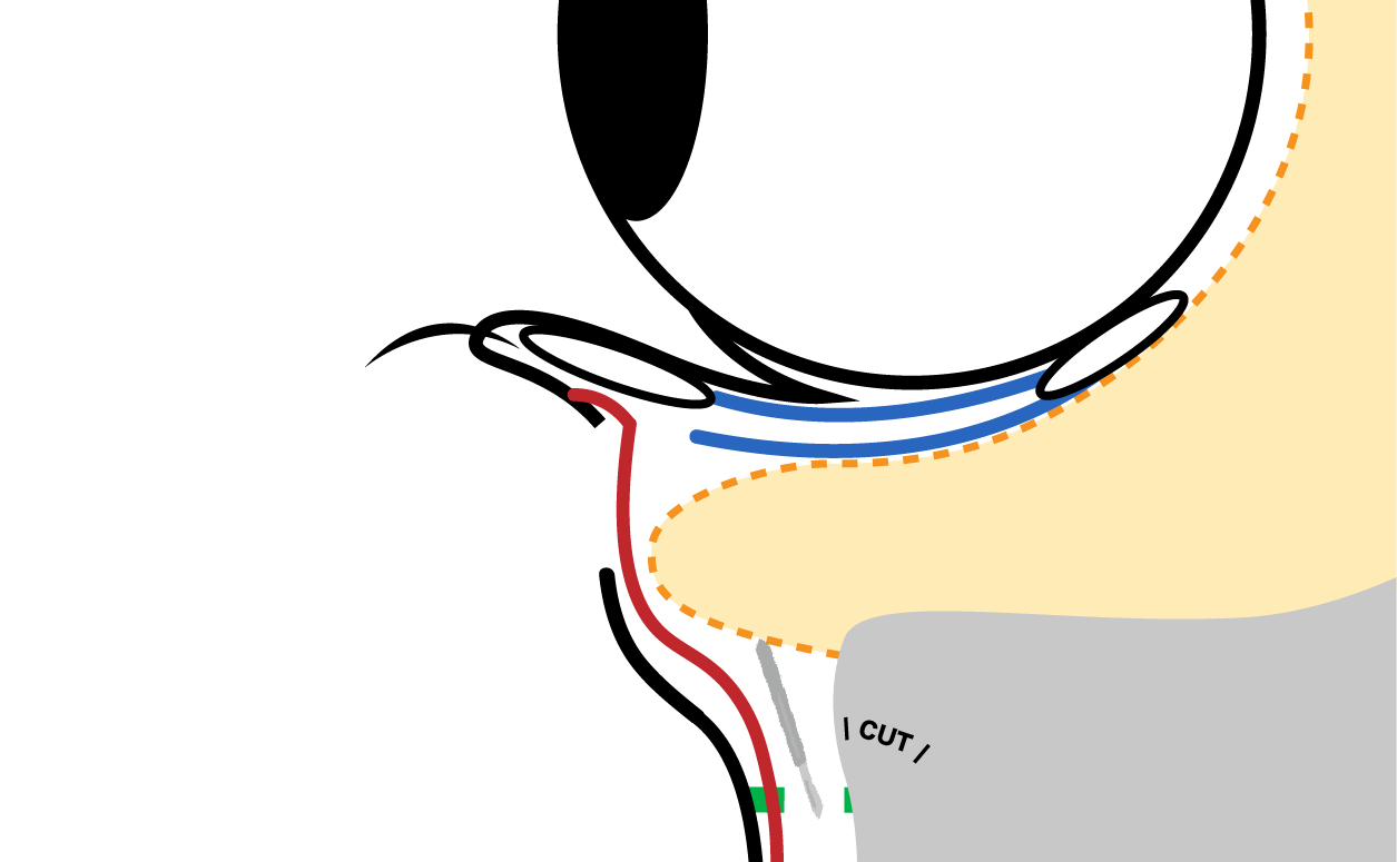 The orbital septum is opened, and the orbital fat flap as well as the composite flap of the septum and anterior leaflet of the CPF are carefully created.