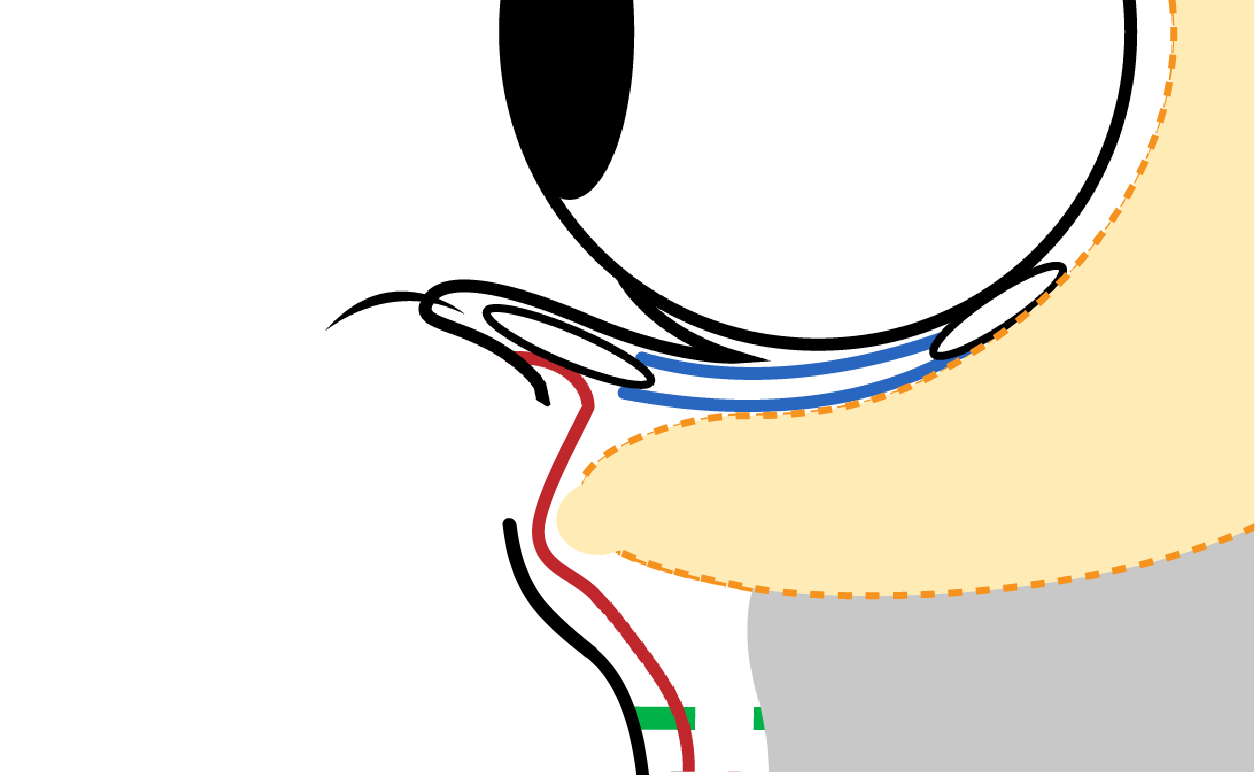 The orbital fat is repositioned beneath the dissected ligament and secured with absorbable sutures. Over time, the fat adheres in this new position, and the sutures are absorbed, completing the procedure.