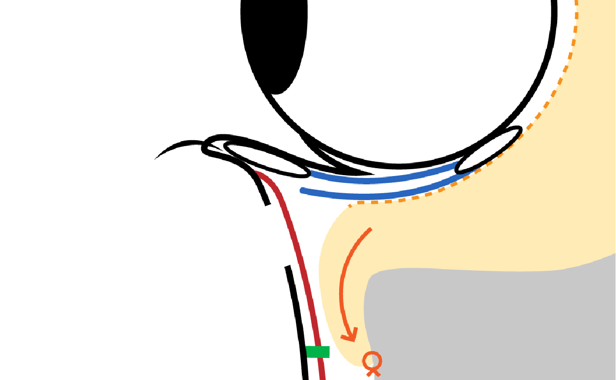 Next, the composite flap of the septum and anterior leaflet of the CPF is sutured along the orbital rim. This step is key for preventing recurrence. (Side view illustration)
