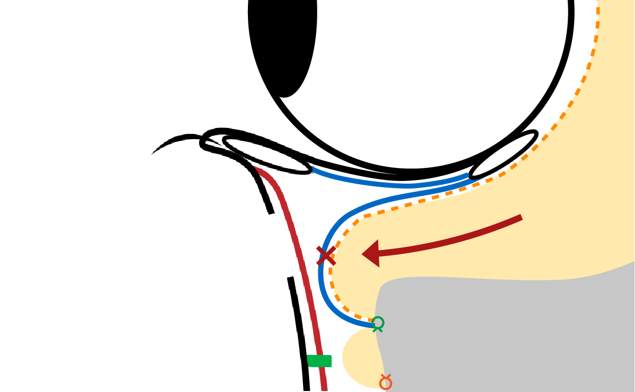 Next, the composite flap of the septum and anterior leaflet of the CPF is sutured along the orbital rim. This step is key for preventing recurrence. (Front view illustration)