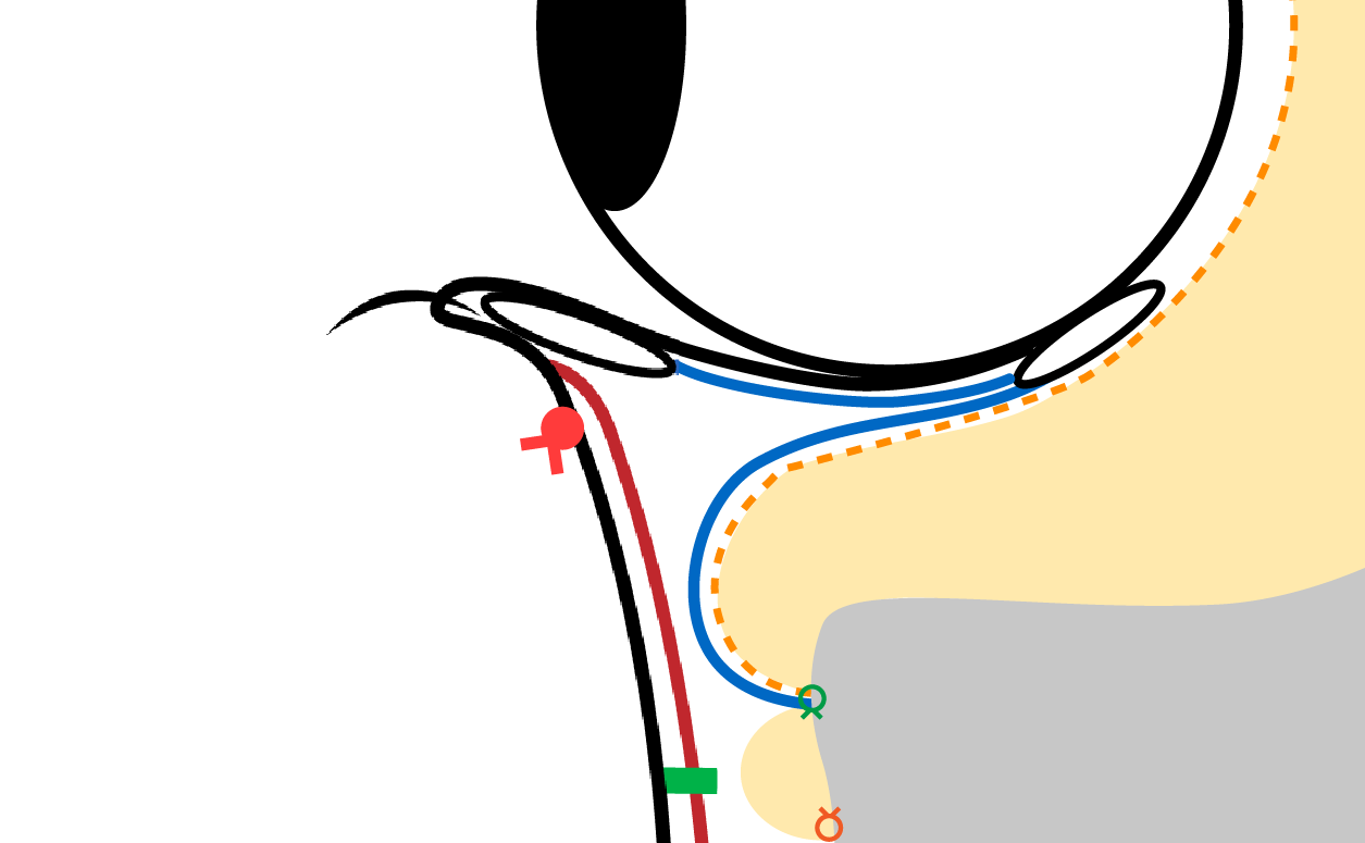 Finally, the skin is sutured to complete the procedure.