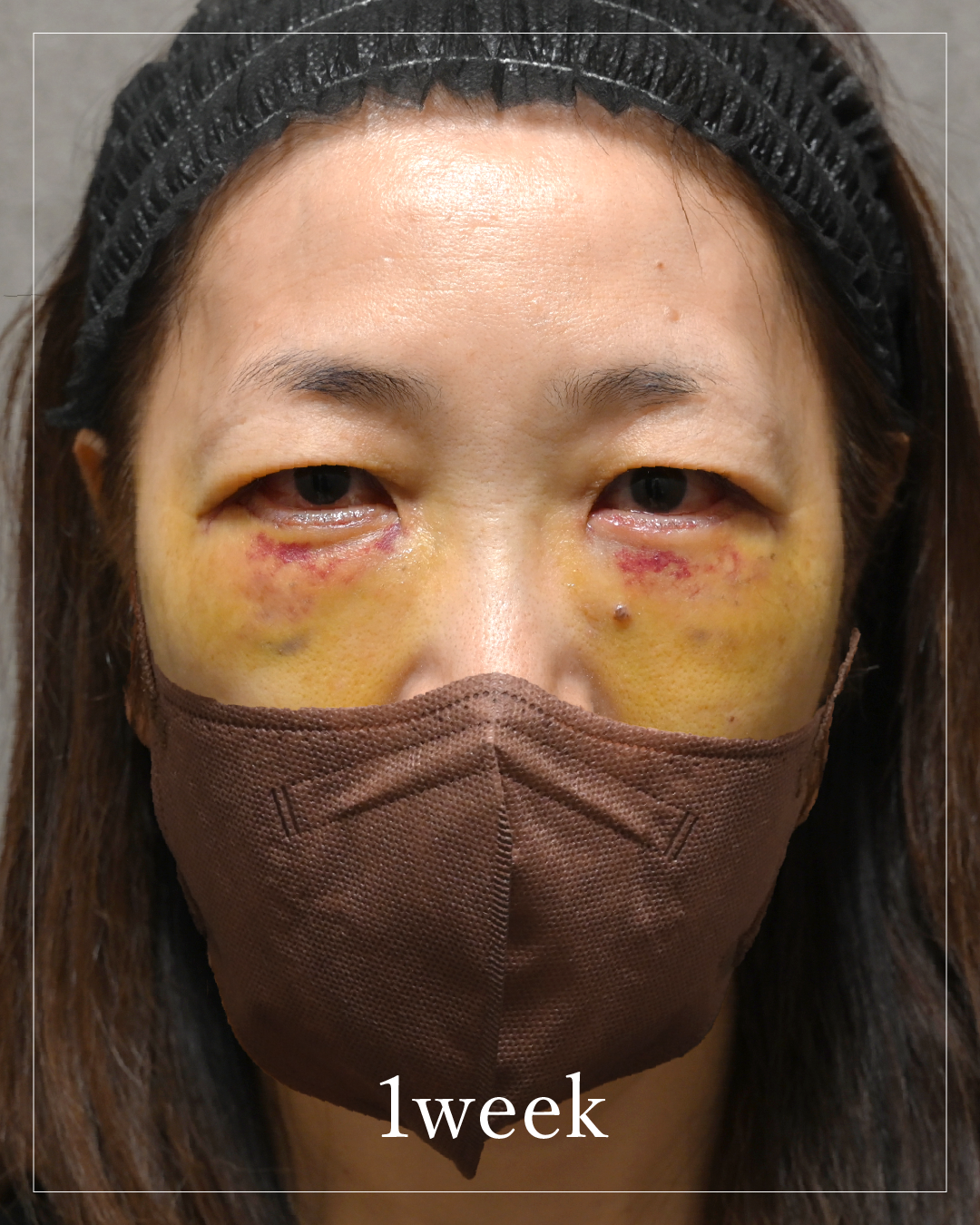 1 Week After the Procedure