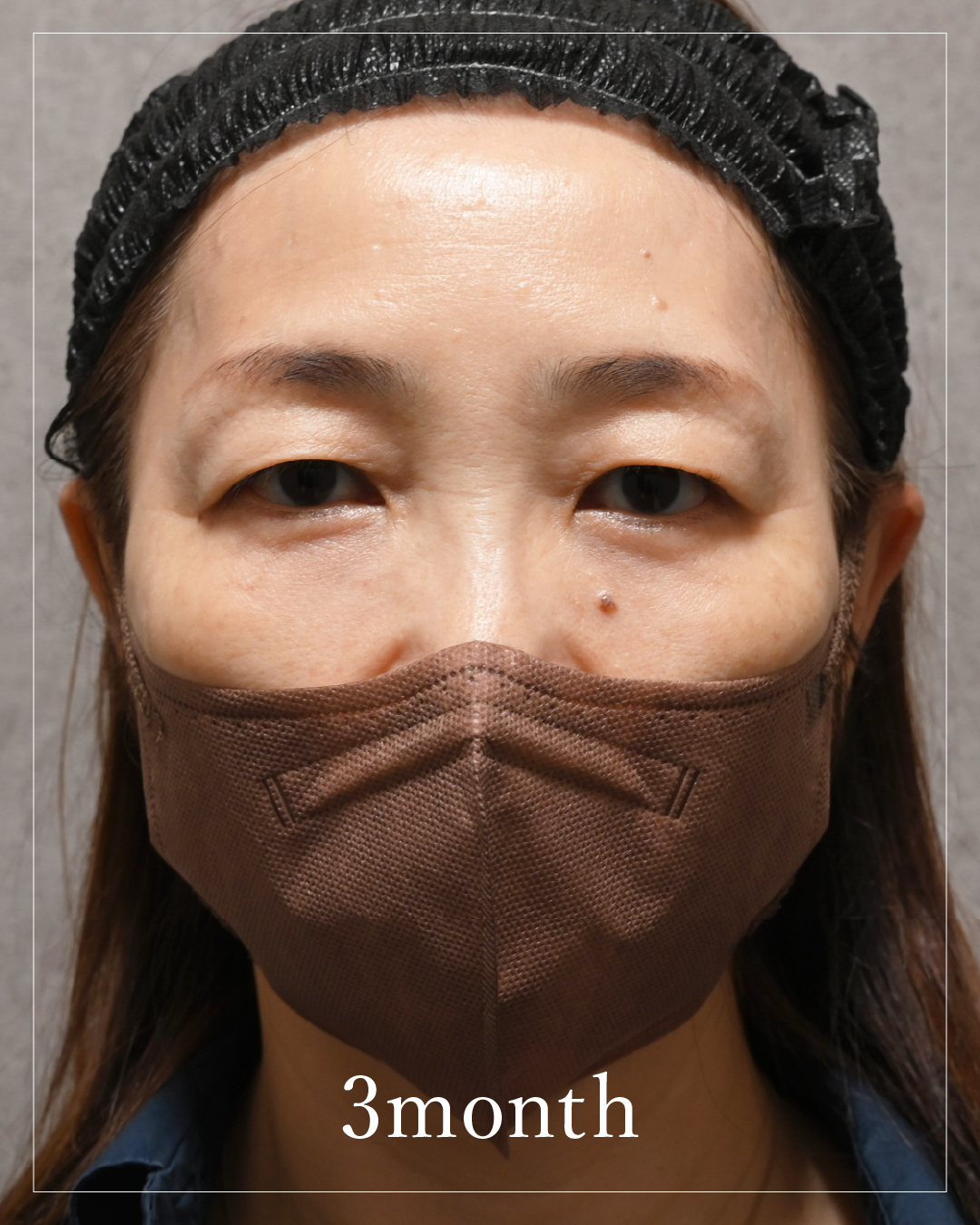 3 months after the procedure
