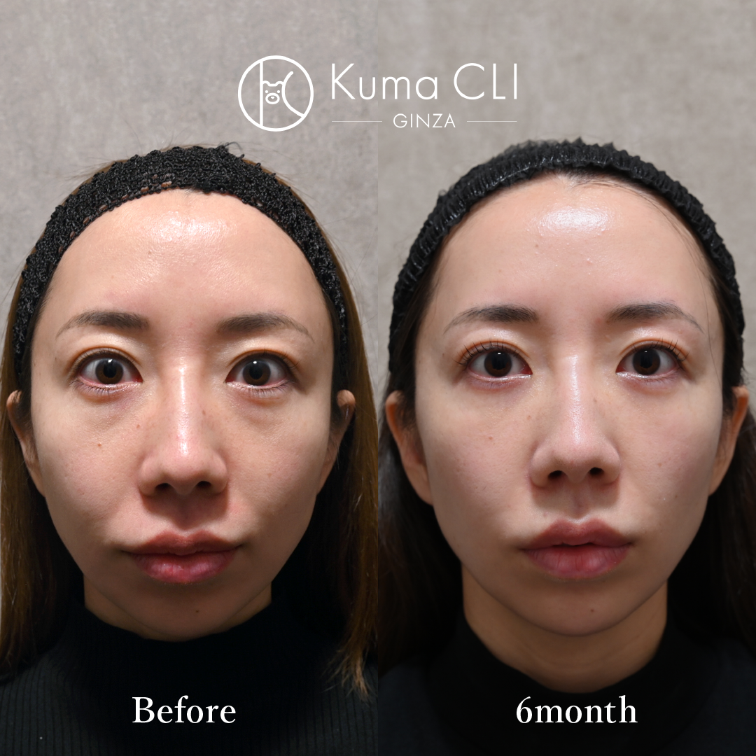 What is Under-Eye Dark Circle Removal?