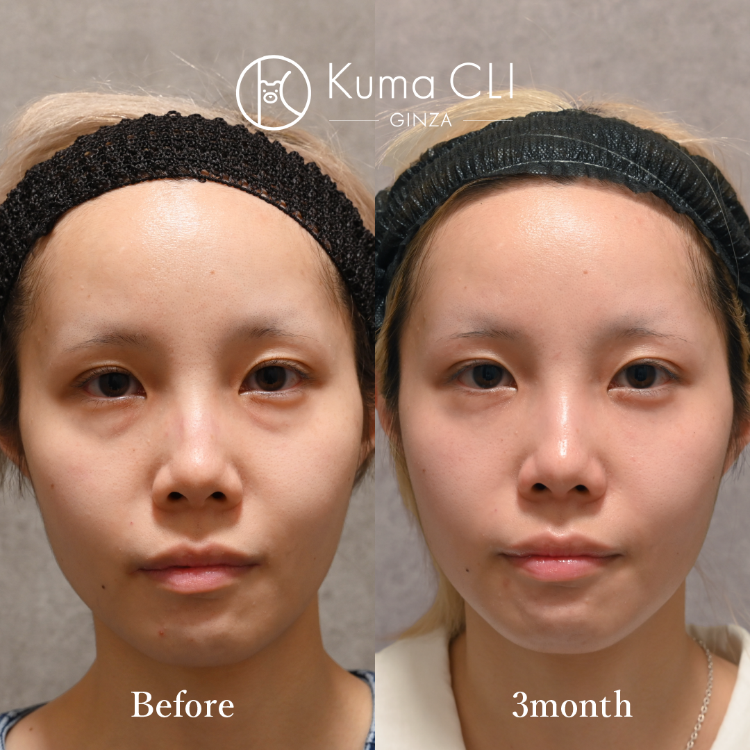 Transconjunctival Orbital Fat Repositioning evo