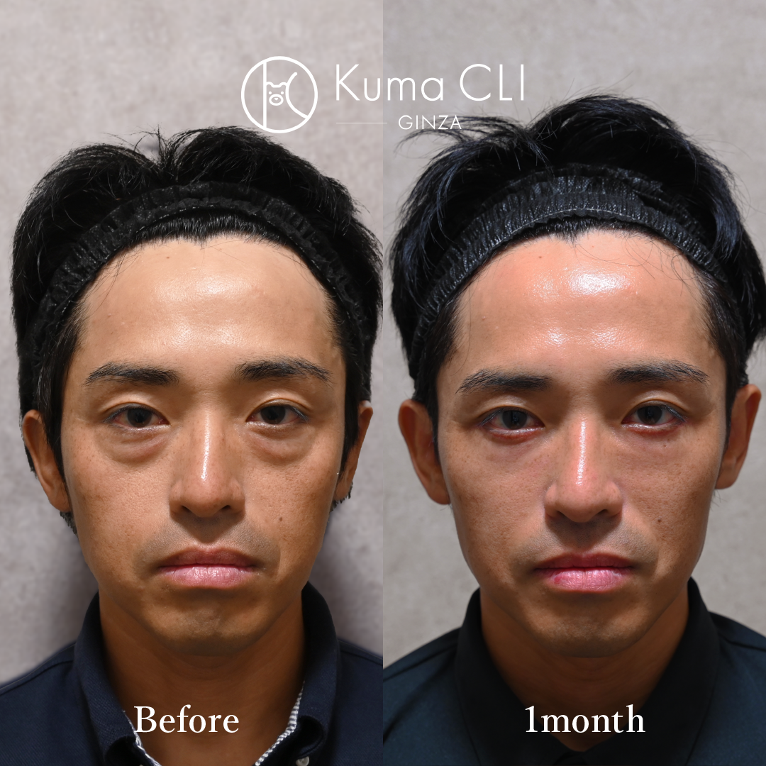 Subciliary Orbital Fat Repositioning