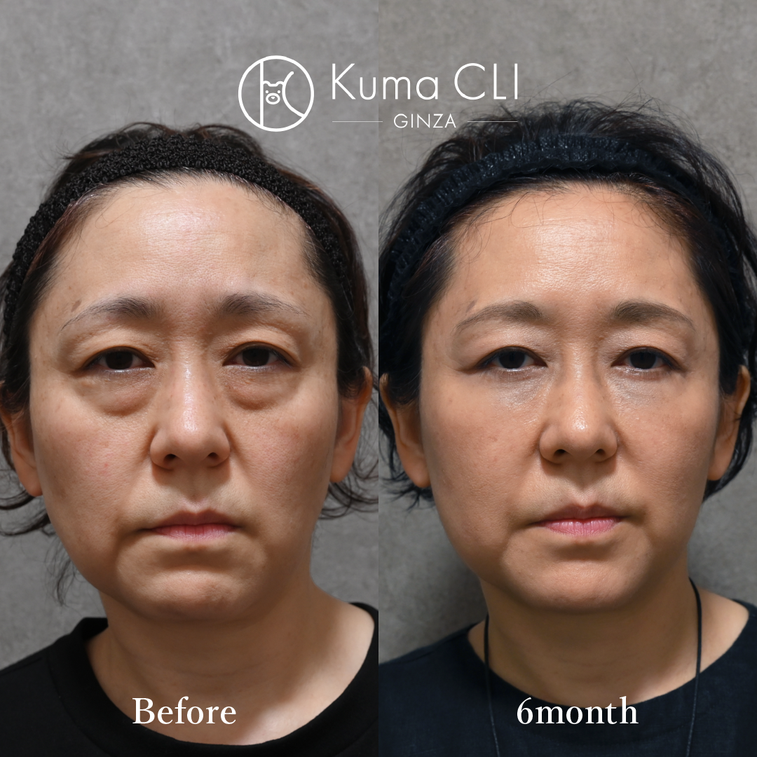 Midface Lift Method(Transcutaneous Midface Lift)