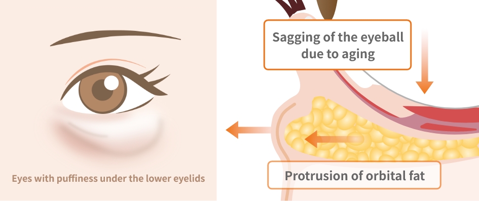 Causes of Dark Circles