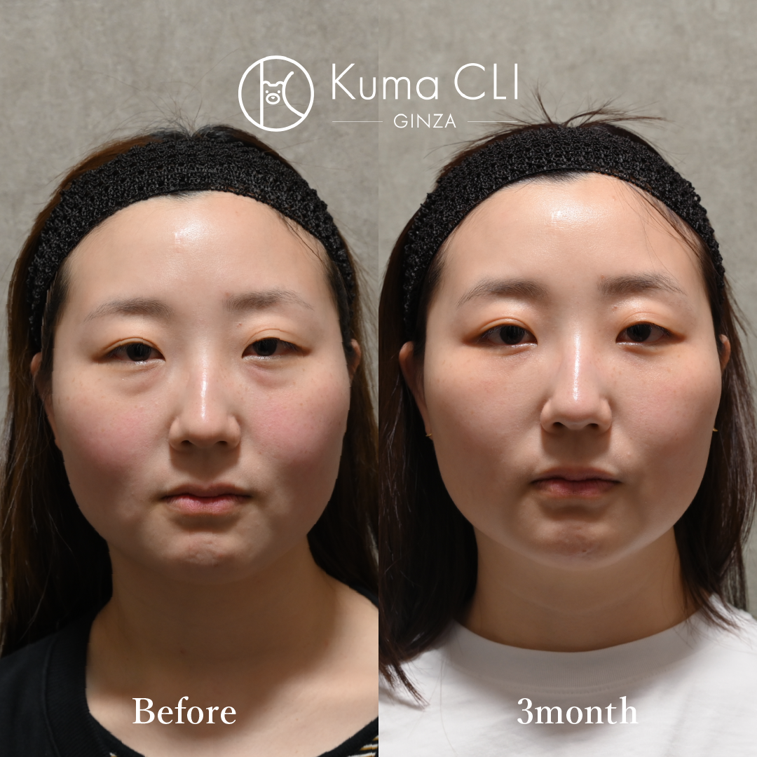 Transconjunctival Orbital Fat Repositioning evo