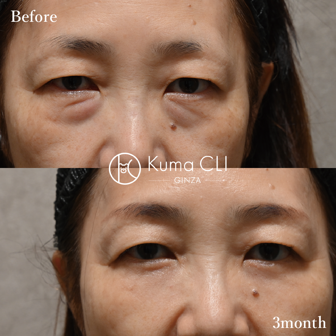 Subciliary Orbital Fat Repositioning Method