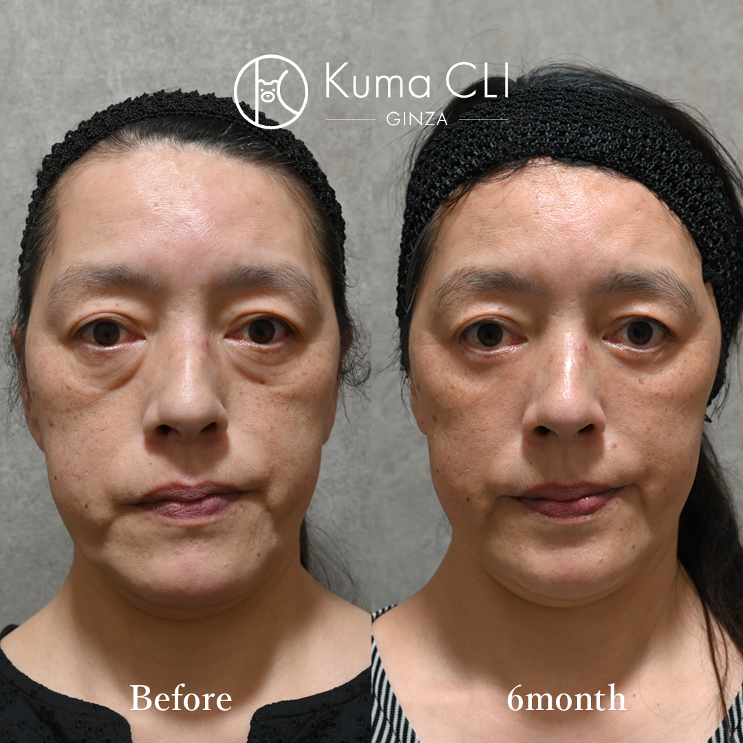 Transcutaneous Midface Lift