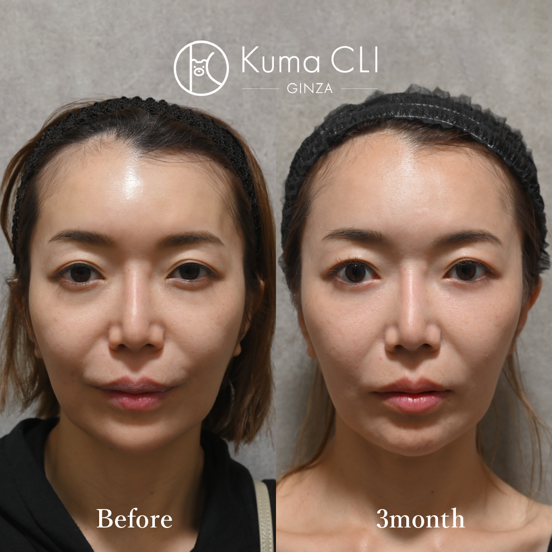 Evo Lift (Under-Eye)