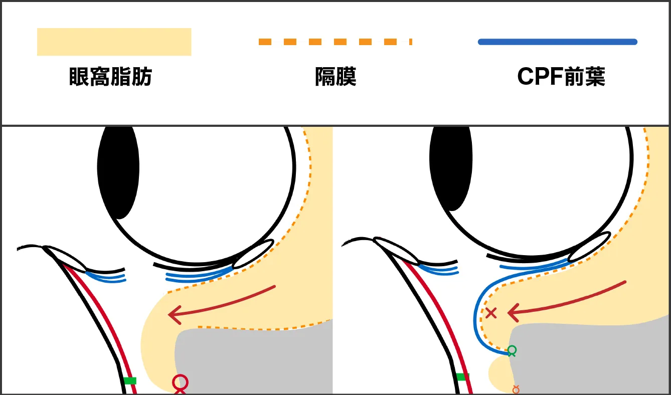 CPF再配置による再発予防の図解