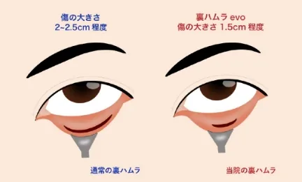 通常の裏ハムラと当院の裏ハムラの傷の大きさ比較
