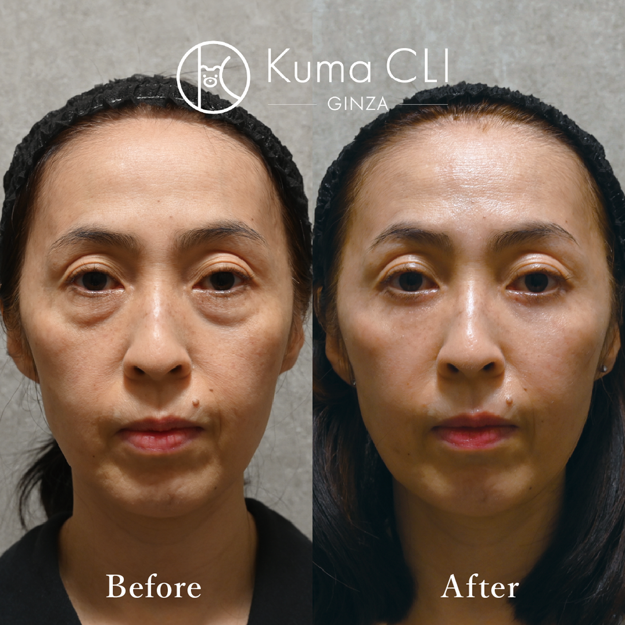 クマ治療症例写真