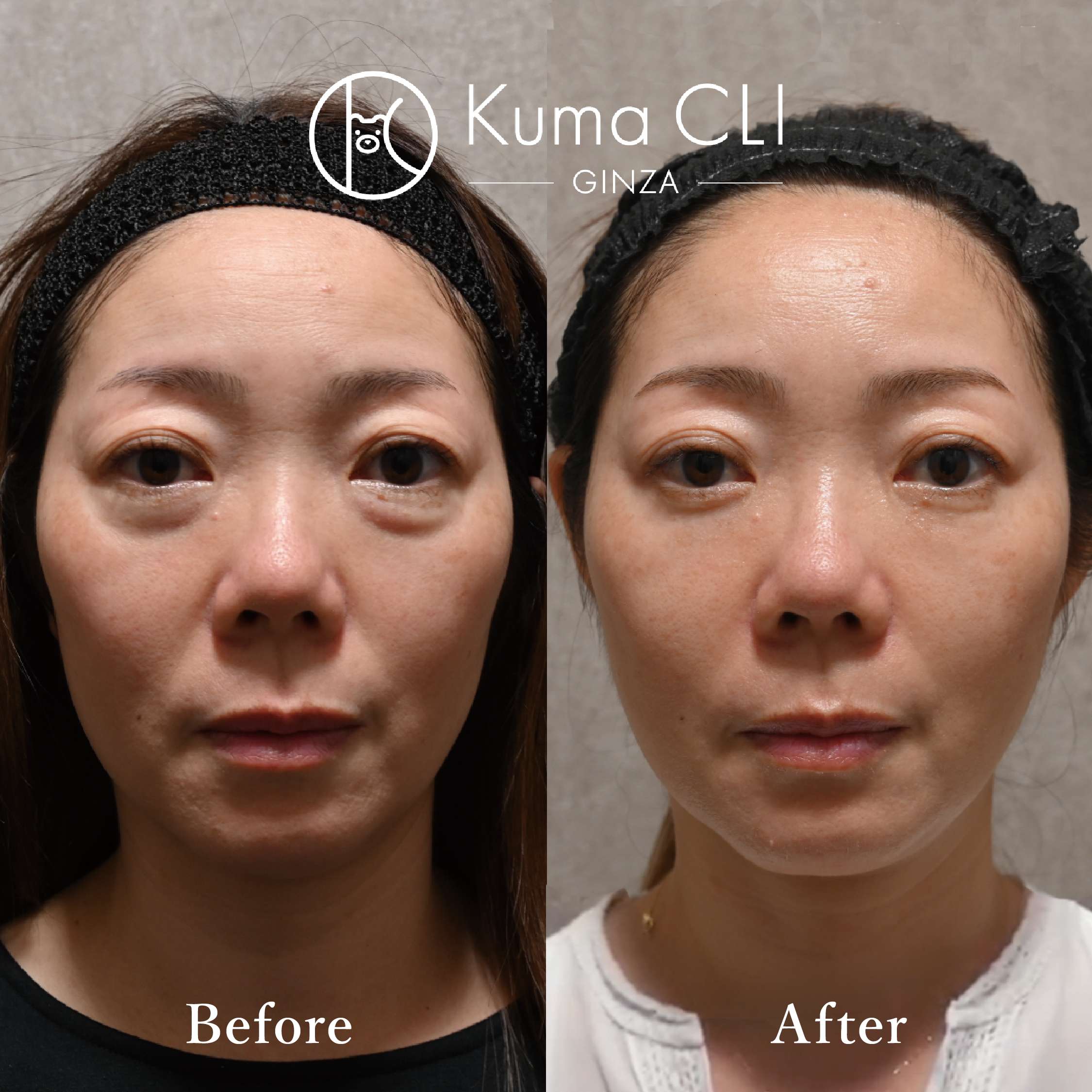 クマ治療症例写真