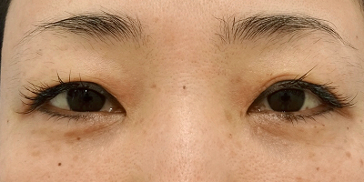 脱脂症例写真