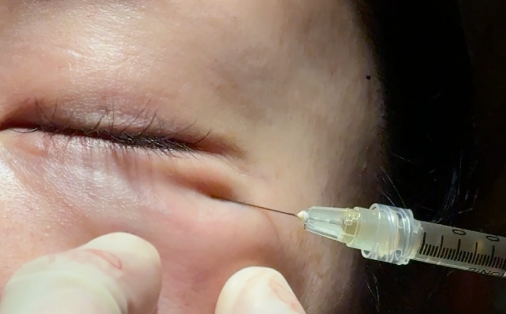 PRPの施術の流れ