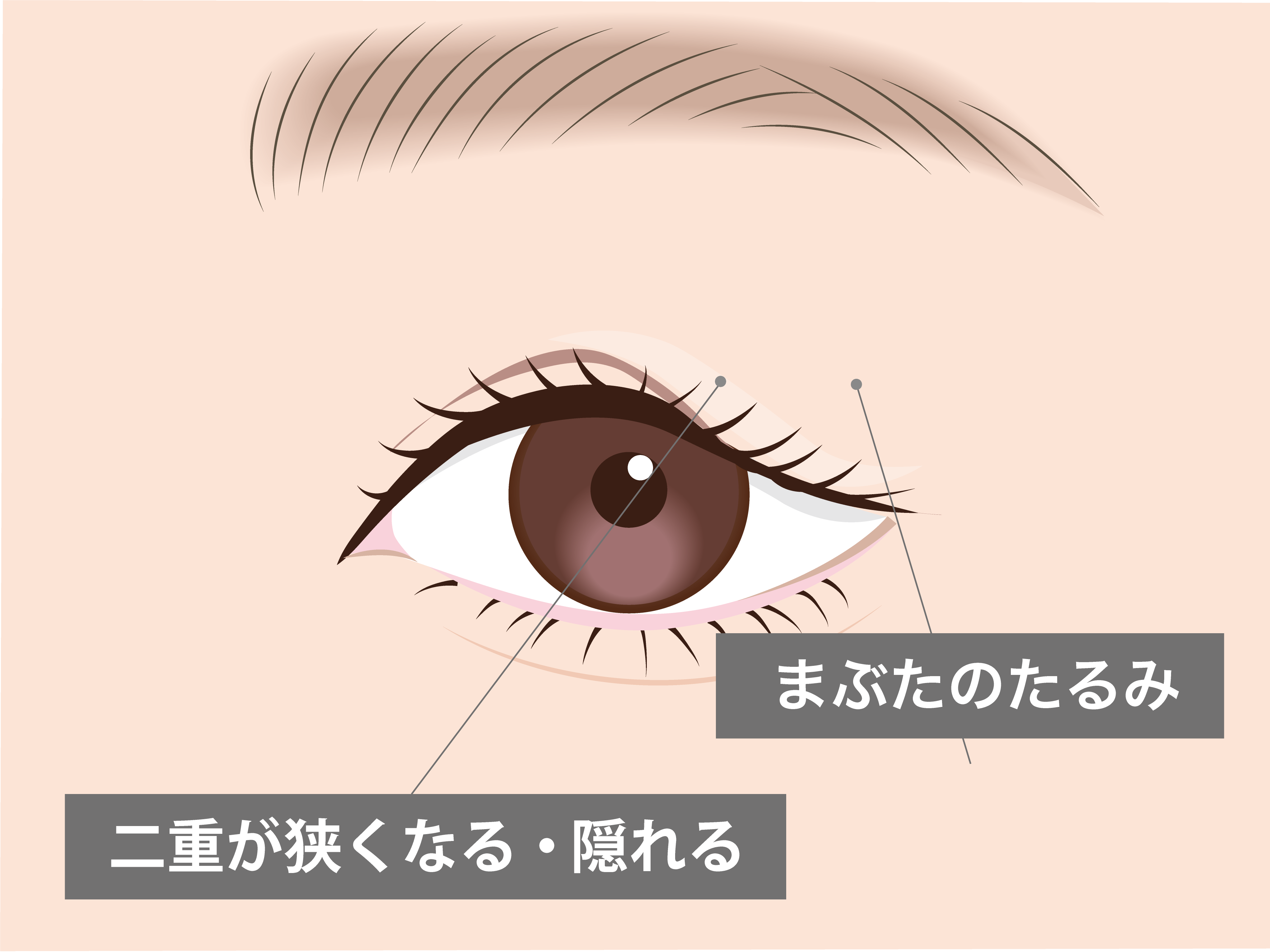 眉下切開が適応の方