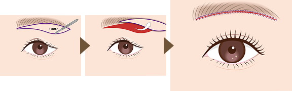 眉下切開とは
