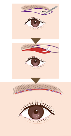 眉下切開とは