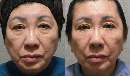 眉下切開×アートメイク