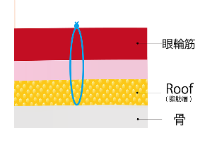 眼輪筋弁を用いたつり上げ法