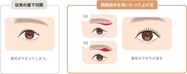 従来法と眼輪筋弁つり上げ法比較