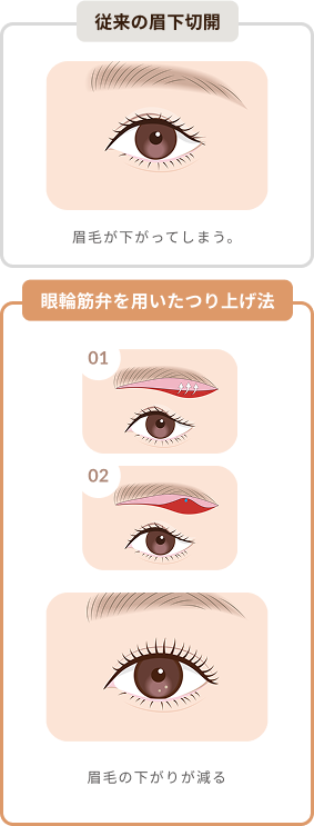 従来法と眼輪筋弁つり上げ法比較
