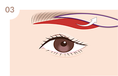 たるみ皮膚を切除