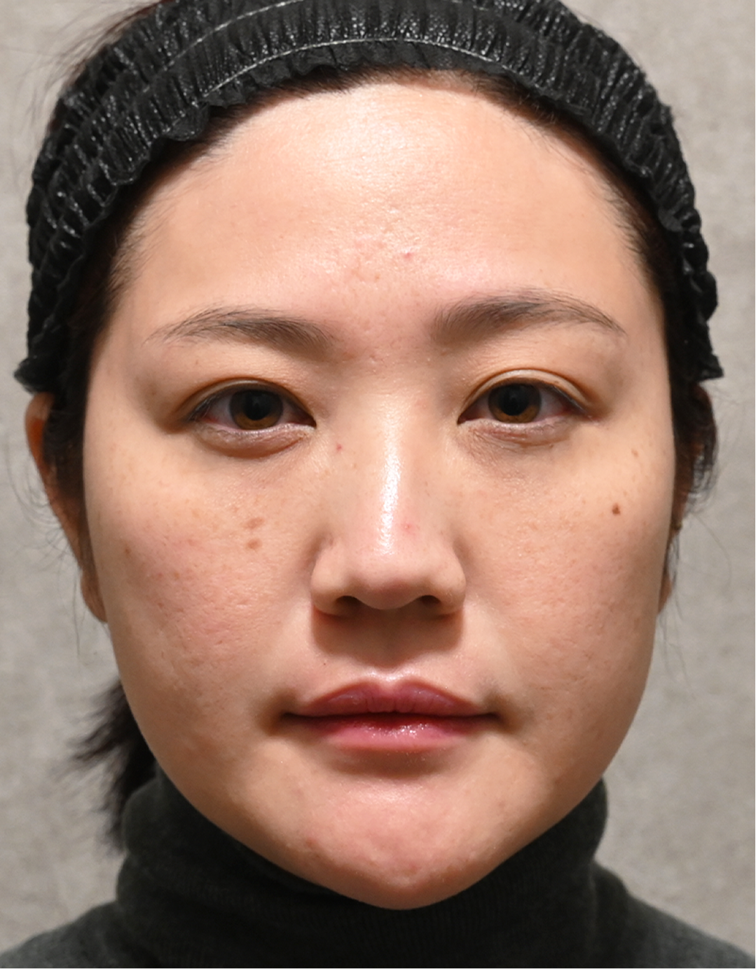 purePRP After