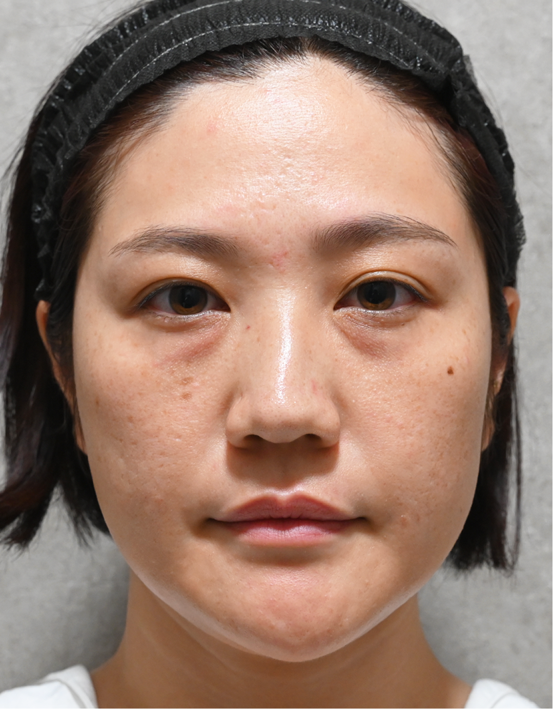 purePRP Before