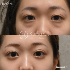 裏ハムラ 症例写真 裏ハムラ法evo 目の下のクマ取り ビフォーアフター