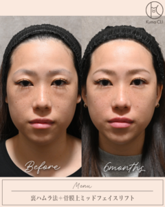 裏ハムラ法＋骨膜上ミッドフェイスリフト