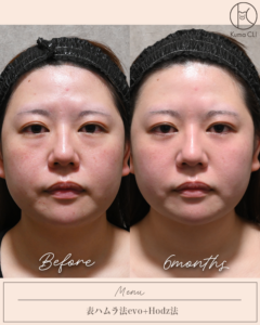 表ハムラ法evo＋Hodz法