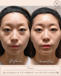 裏ハムラ法evo＋ナノリッチ目の下＋コンデンスリッチゴルゴ線