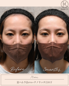 裏ハムラ法evo＋ナノリッチ目の下