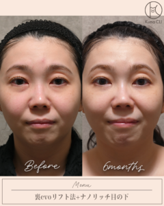 裏evoリフト法＋ナノリッチ目の下