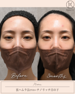 裏ハムラ法evo＋ナノリッチ目の下